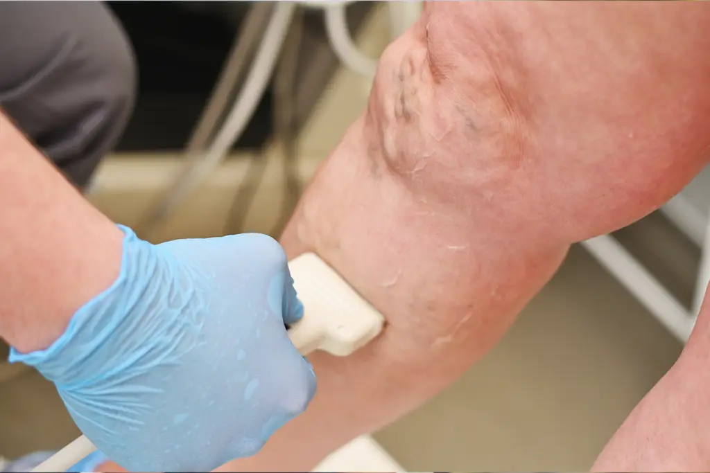 Limb Salvage at Al-Zoubaidi Vein & Vascular Center of Southern Illinois